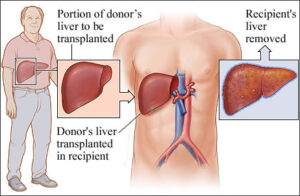 liver-transplant-cost-in-india